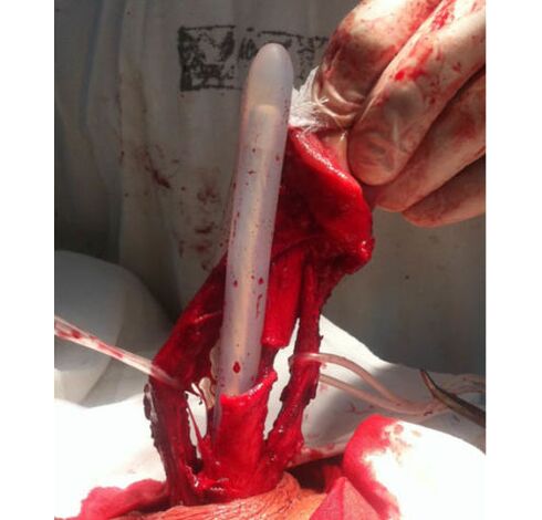 Muscle tissue transplant to enlarge the penis