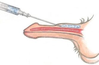 A dangerous method to enlarge the penis using Vaseline injections.